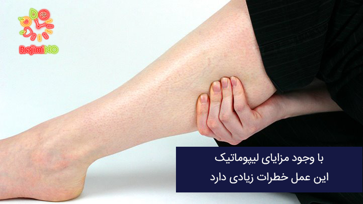 لیپوماتیک ساق پا اصفهان